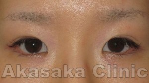 PreOP (2)_