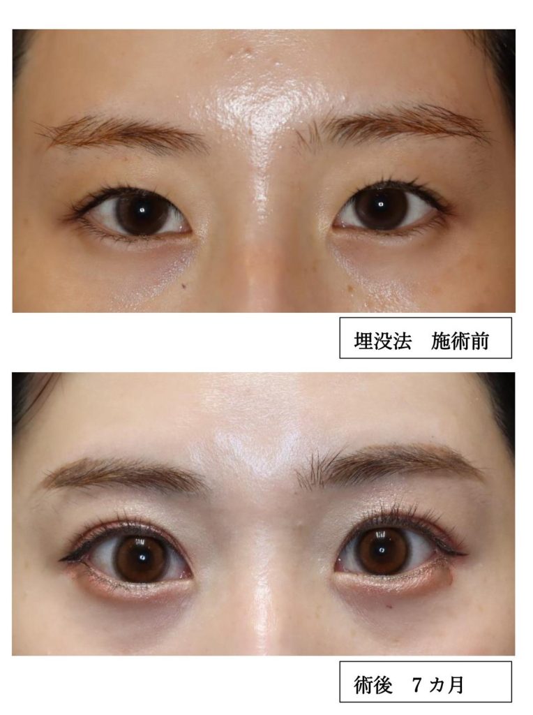 二重まぶた埋没法 ビフォーアフター