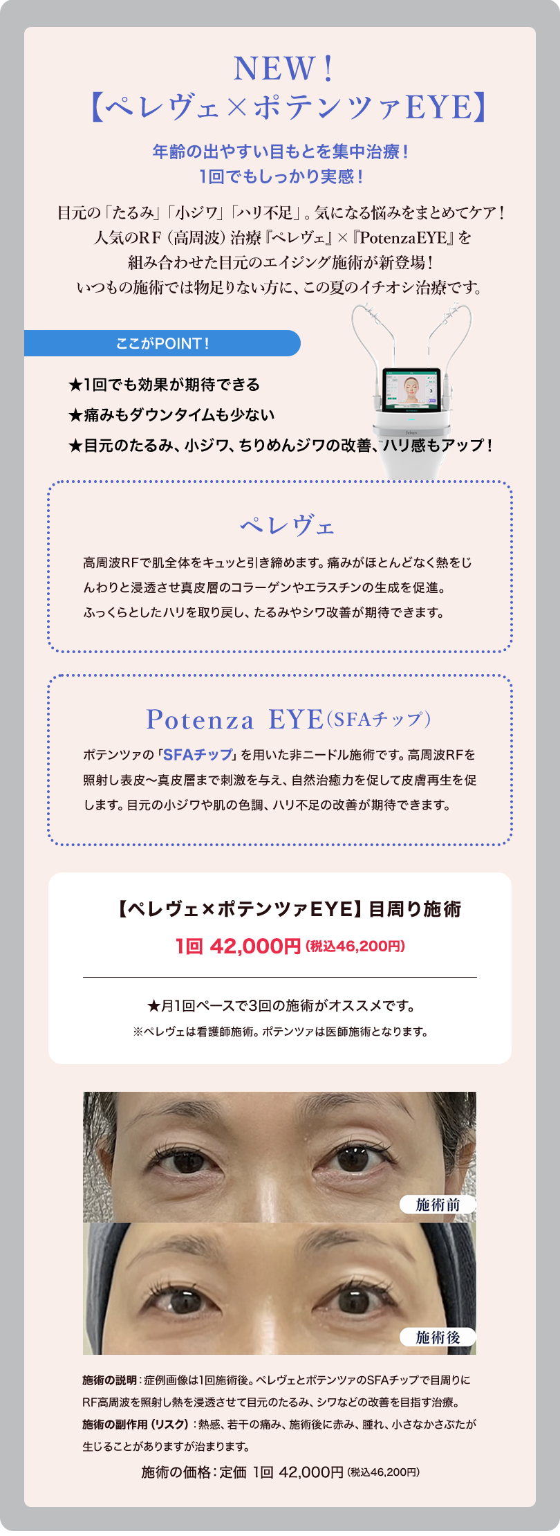 �y�����F���|�e���c�@